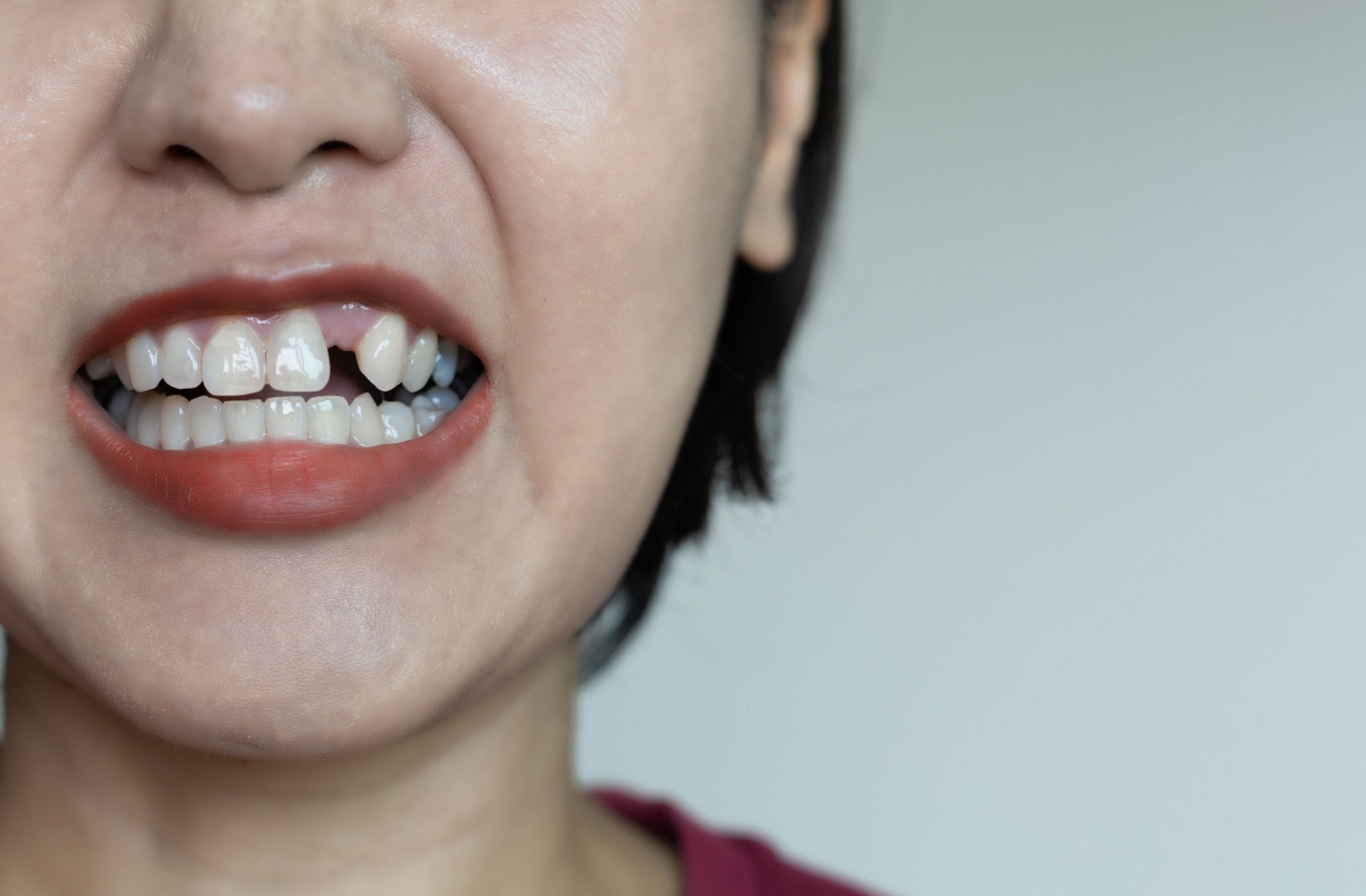 Against a plain background, a dental patient wearing red lipstick half-smiles, showing a missing incisor tooth.