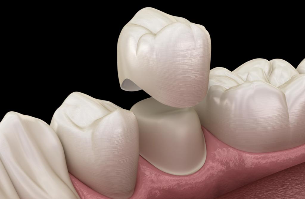 Dental crown being placed over a prepared tooth between surrounding natural teeth.