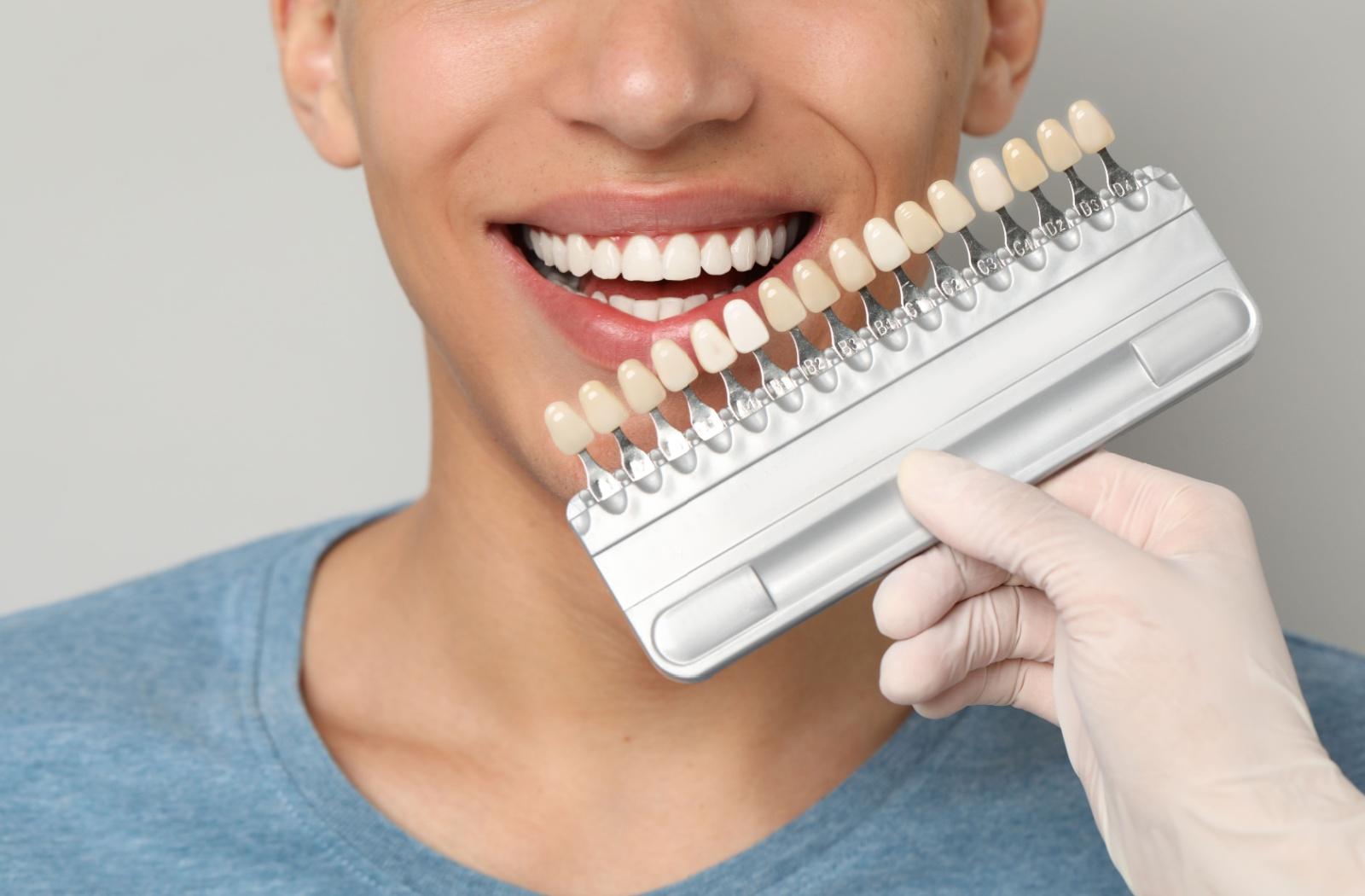 Patient smiling while a dental professional compares tooth shades for cosmetic dental treatment.